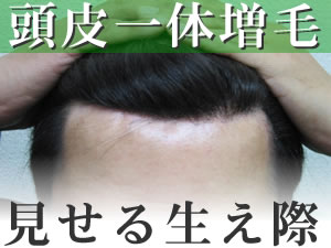 【頭皮一体増毛】ヘアーインプラントEX フロント用(男性かつら)(※装着には別途、強力テープかスーパーシリコンの購入が必要です)【送料無料】部分かつら