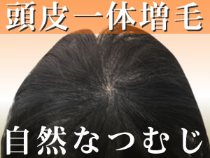 【頭皮一体増毛】ヘアーインプラントEX つむじ用(男性かつら)(※装着には別途、強力テープかスーパーシリコンの購入が必要です)【送料無料】（かつら・増毛・ウィッグ・男性用かつら・女性用かつら）部分かつら