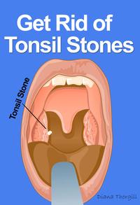 Get Rid of Tonsil Stones: Causes Symptoms Treatment Removal and Other RemediesydqЁz[ Diana Thorgill ]