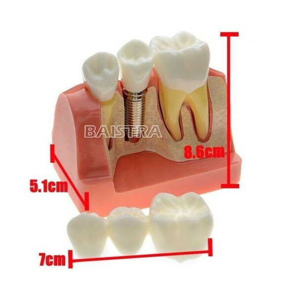 歯科模型 歯列模型 インプラント　ブリッジ