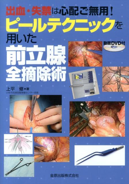 ピールテクニックを用いた前立腺全摘除術