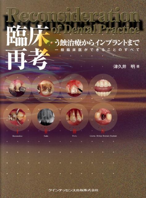 臨床再考・う蝕治療からインプラントまで