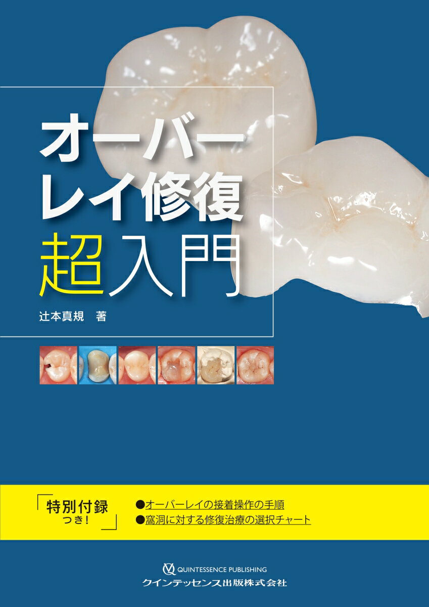 オーバーレイ修復 超入門