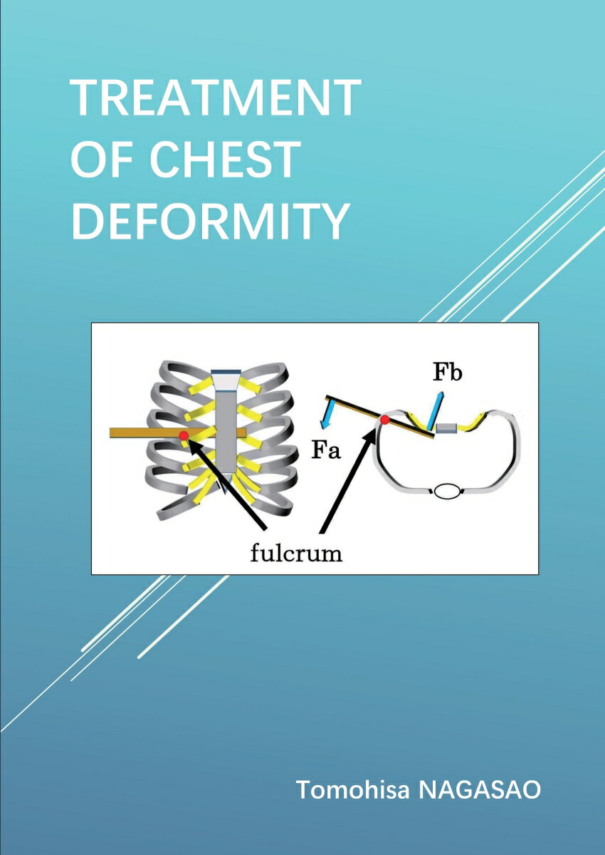 【POD】Treatment of Chest Deformity