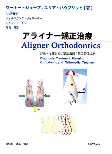 アライナー矯正治療