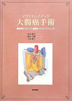 イラストレイテッド大腸癌手術