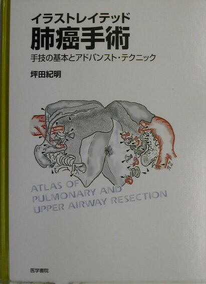 イラストレイテッド肺癌手術