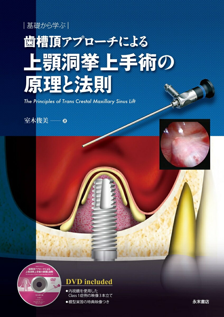 基礎から学ぶ　歯槽頂アプローチによる　上顎洞拳上手術の原理と法則