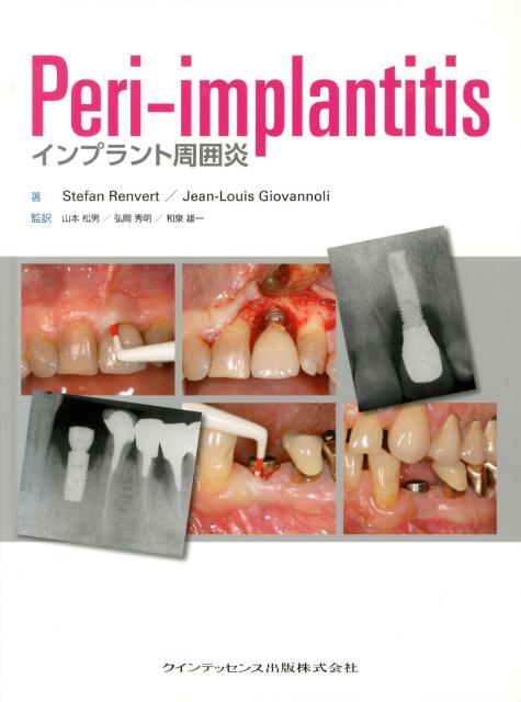 Peri-implantitis