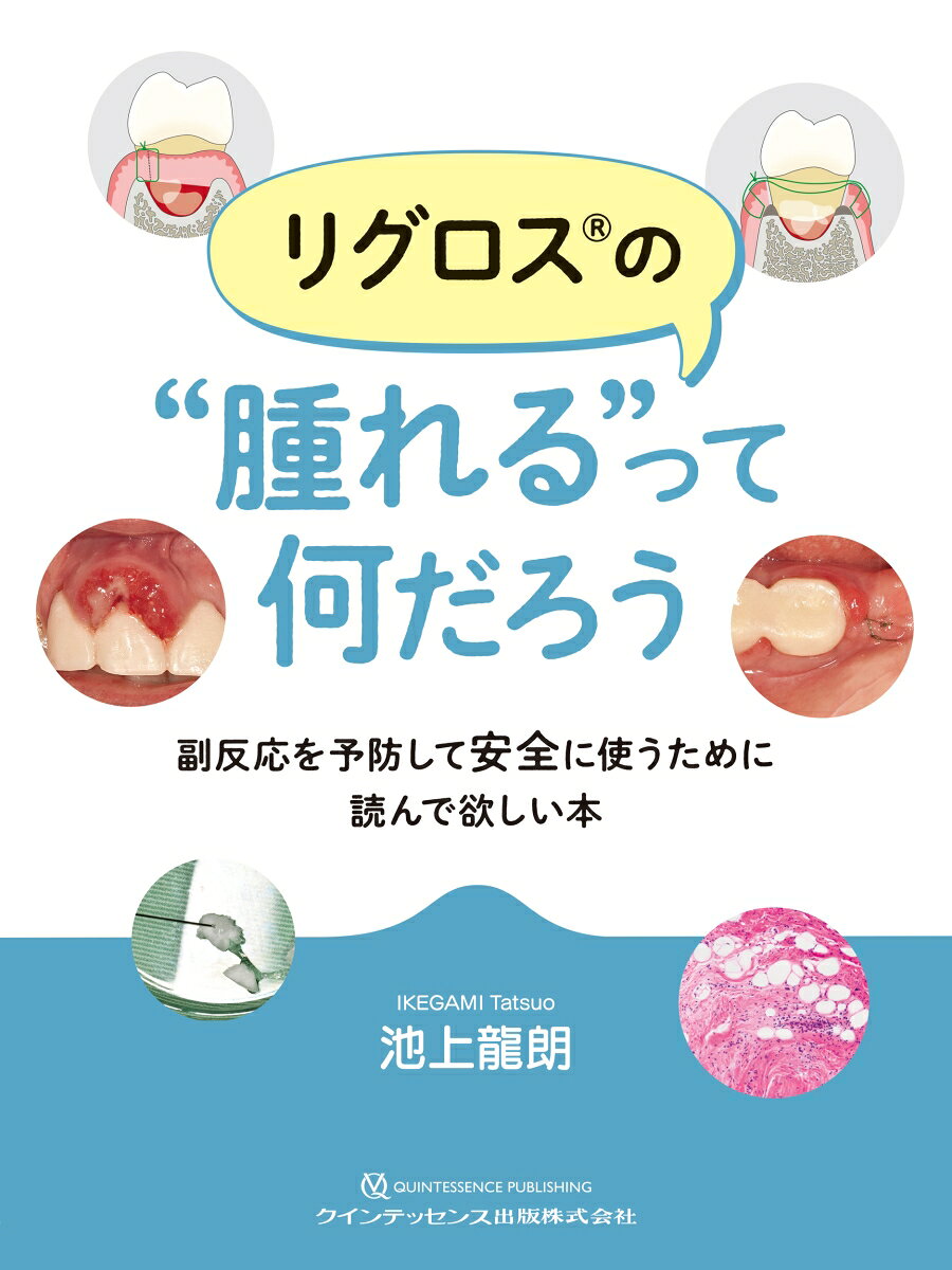リグロス®の“腫れる”って何だろう : 副反応を予防して安全に使うために読んで欲しい本 書影