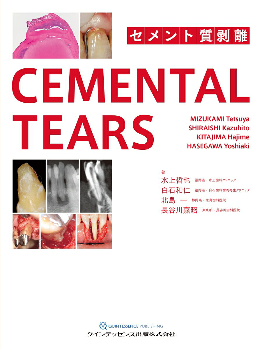 歯周病や根尖病変のような骨吸収像を示すことから鑑別・治療方法を誤ってしまう今話題のセメント質剥離。内掘れ型や楔状の骨吸収像を示し、歯周治療・再生療法などの処置が必要になる。セメント質剥離の原因は？　好発部位・年齢・性別などは？　外部と交通せず感染していないはずなのに骨欠損が起こるのはなぜ？　他の病変との骨欠損形態の違いは？　セメント質剥離片は除去すべき？　歯根面はどうしたらよい？　治療の予後は？