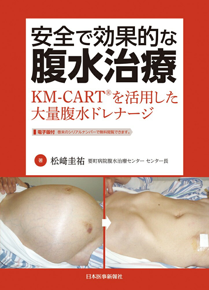 安全で効果的な腹水治療　KM-CART®を活用した大量腹水ドレナージ [ 松崎圭祐 ]