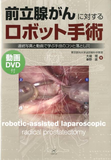 前立腺がんに対するロボット手術