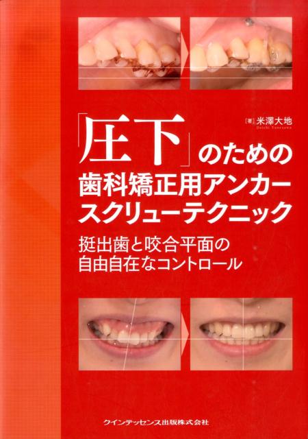 「圧下」のための歯科矯正用アンカースクリューテクニック