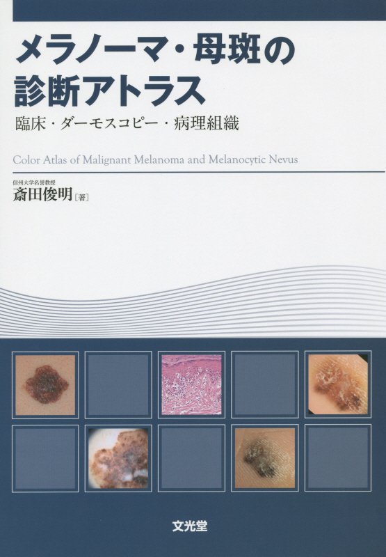 メラノーマ・母斑の診断アトラス