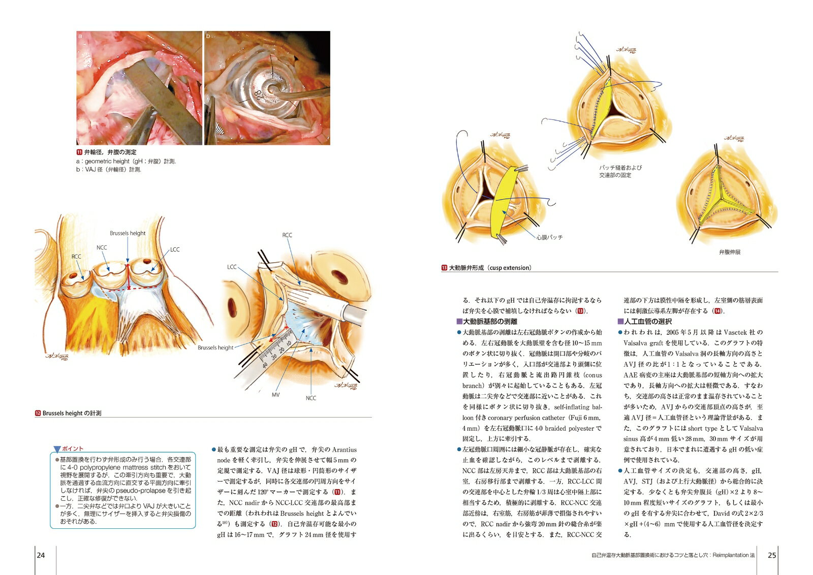 大動脈疾患の手術（第4巻） （心臓血管外科手術エクセレンス） [ 大北裕 ] 3