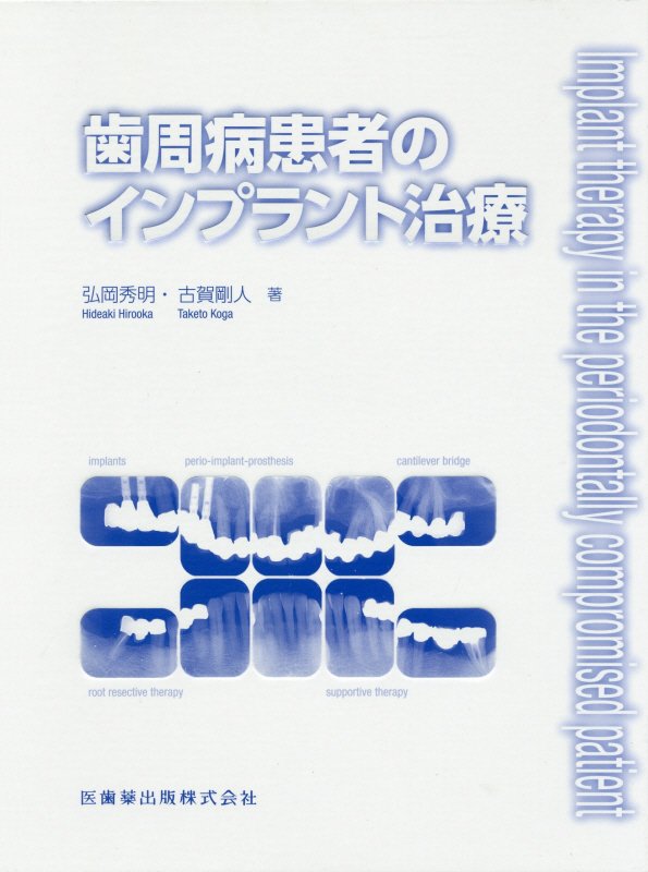 歯周病患者のインプラント治療