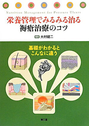 栄養管理でみるみる治る褥瘡治療のコツ