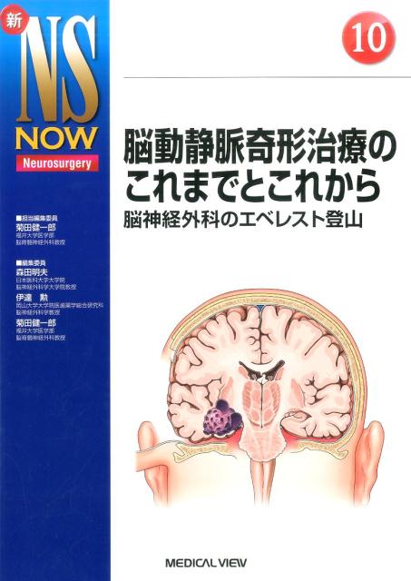脳動静脈奇形治療のこれまでとこれから