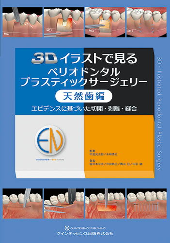 3Dイラストで見るペリオドンタルプラスティックサージェリー 天然歯編
