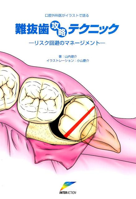 口腔外科医がイラストで語る難抜歯攻略テクニック