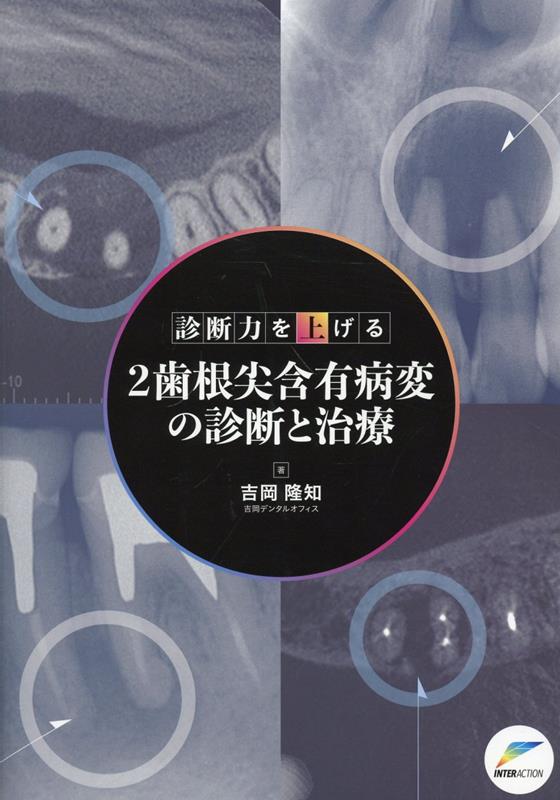 診断力を上げる　2歯根尖含有病変の診断と治療