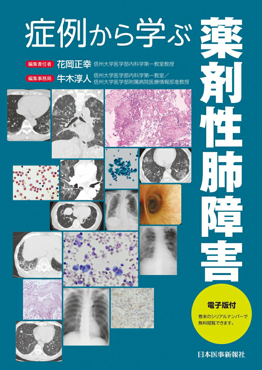 症例から学ぶ薬剤性肺障害【電子版付】