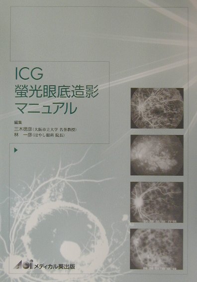 ICG螢光眼底造影マニュアル