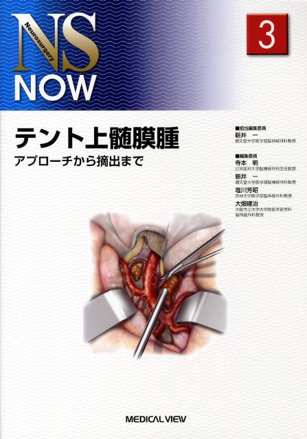 テント上髄膜腫