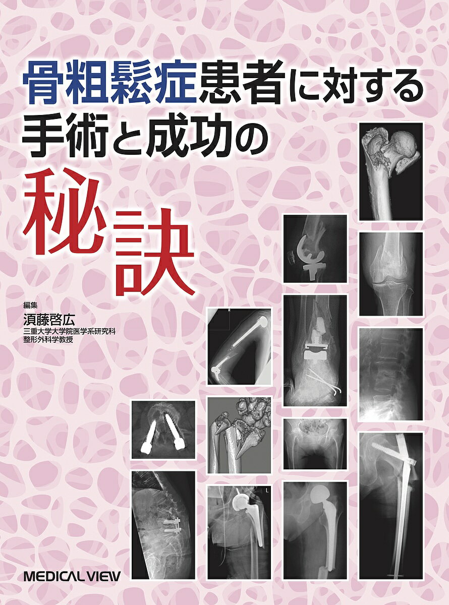 著者【ス】藤啓広(編集)出版社メジカルビュー社発売日2019年10月ISBN9784758318747ページ数247Pキーワードこつそしようしようかんじやにたいするしゆじゆつとせ コツソシヨウシヨウカンジヤニタイスルシユジユツトセ すどう あきひろ スドウ アキヒロ9784758318747内容紹介骨粗鬆症患者の手術においては，若年者と異なり骨の脆弱性に配慮することが必要になる。本書では脊椎・上肢・下肢の部位ごとに，術前（手術適応）・術中（手術手技）・術後（離床時期，合併症への対応）でそれぞれポイントとなる事項を記載し，また脆弱骨で起こりやすいインプラント周囲骨折についても記述した。術前対策では，万が一に備えて術前に「準備しておくもの」を項目ごとに記載し，また術中で特に重要な事項は「成功の秘訣」として別枠で掲載。術前後の骨粗鬆症治療薬の使い分けや服用期間など，骨折連鎖防止への対処法についても言及した。※本データはこの商品が発売された時点の情報です。目次骨粗鬆症患者に対する手術（総論）/脊椎手術/上肢手術/下肢手術/その他の手術