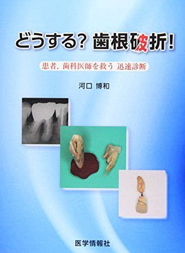 どうする?歯根破折!―患者，歯科医師を救う迅速診断 [大型本] 河口 博和