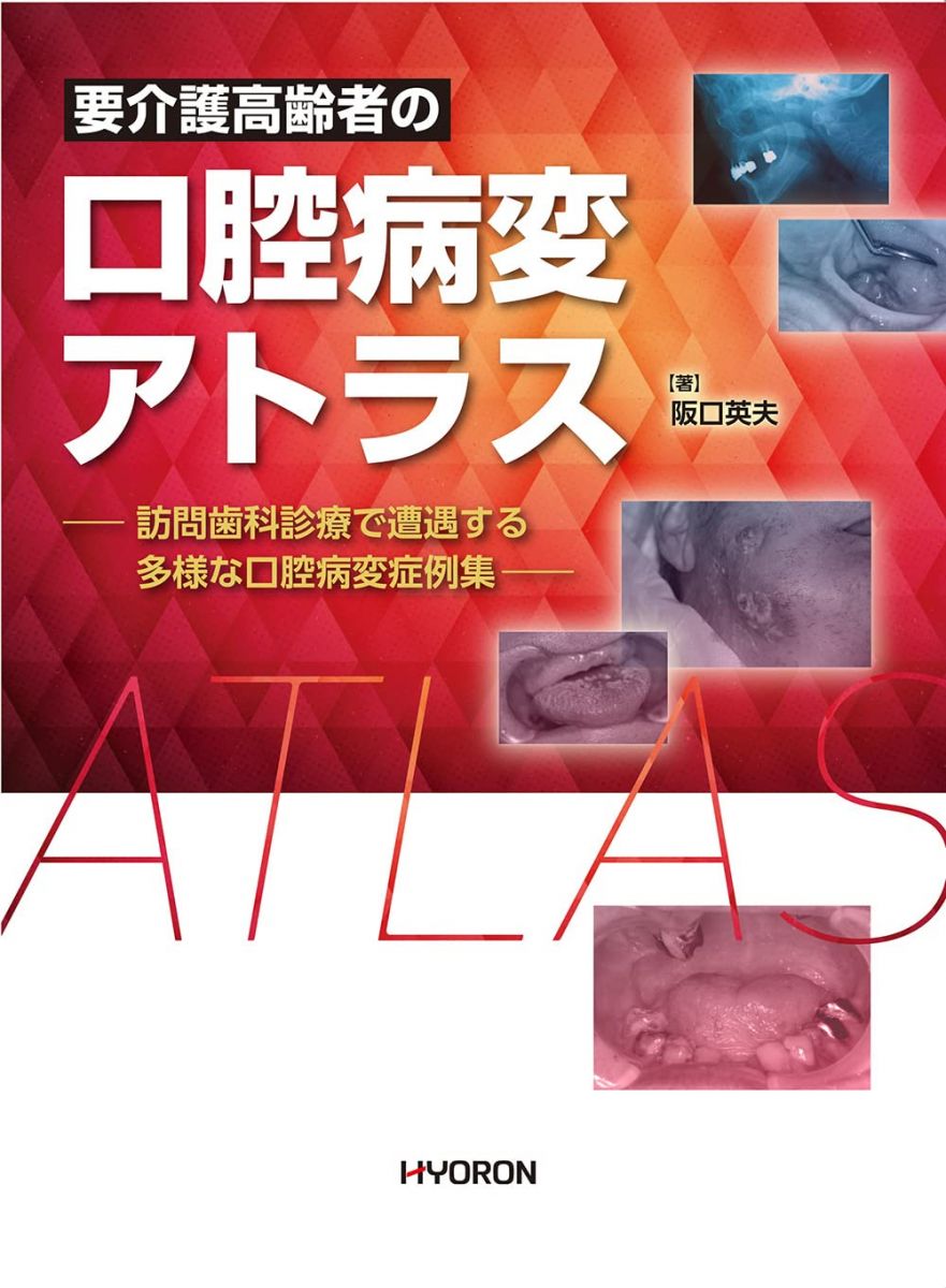 【30日間返品保証】商品説明に誤りがある場合は、無条件で弊社送料負担で商品到着後30日間返品を承ります。【最短翌日到着】正午12時まで（日曜日は午前9時まで）の注文は当日発送（土日祝も発送）。関東・関西・中部・中国・四国・九州地方は翌日お届け、東北地方・新潟県・北海道・沖縄県は翌々日にお届けします。【インボイス制度対応済み】当社ではインボイス制度に対応した適格請求書発行事業者番号（通称：T番号・登録番号）を印字した納品書（明細書）を商品に同梱してお送りしております。こちらをご利用いただくことで、税務申告時や確定申告時に消費税額控除を受けることが可能になります。また、適格請求書発行事業者番号の入った領収書・請求書をご注文履歴からダウンロードしていただくこともできます（宛名はご希望のものを入力していただけます）。ご満足のいく取引となるよう精一杯対応させていただきます。※下記に商品説明およびコンディション詳細、出荷予定・配送方法・お届けまでの期間について記載しています。ご確認の上ご購入ください。■商品名■要介護高齢者の口腔病変アトラス■出版社■?ヒョーロン・パブリッシャーズ■著者■阪口英夫■発行年■2023/03/24■ISBN10■4864320772■ISBN13■9784864320771■コンディションランク■非常に良いコンディションランク説明ほぼ新品：未使用に近い状態の商品非常に良い：傷や汚れが少なくきれいな状態の商品良い：多少の傷や汚れがあるが、概ね良好な状態の商品(中古品として並の状態の商品)可：傷や汚れが目立つものの、使用には問題ない状態の商品■コンディション詳細■書き込みありません。古本ではございますが、使用感少なくきれいな状態の書籍です。弊社基準で良よりコンデションが良いと判断された商品となります。水濡れ防止梱包の上、迅速丁寧に発送させていただきます。【発送予定日について】正午12時まで（日曜日は午前9時まで）のご注文は当日に発送いたします。正午12時（日曜日は午前9時）以降のご注文は翌日に発送いたします（土曜日・日曜日・祝日も発送しています）。※土曜日・祝日も正午12時までのご注文は当日に発送いたします。※年末年始（12/31〜1/3）は除きます。(例)・月曜0時〜12時までのご注文：月曜日に発送・月曜12時〜24時までのご注文：火曜日に発送・土曜0時〜12時までのご注文：土曜日に発送・土曜12時〜24時のご注文：日曜日に発送・日曜0時〜9時までのご注文：日曜日に発送・日曜9時〜24時のご注文：月曜日に発送【送付方法について】ネコポス、宅配便またはレターパックでの発送となります。東北地方・新潟県・北海道・沖縄県・離島以外は、発送翌日に到着します。東北地方・新潟県・北海道・沖縄県・離島は、発送後2日での到着となります。商品説明と著しく異なる点があった場合や異なる商品が届いた場合は、到着後30日間は無条件で着払いでご返品後に返金させていただきます。メールまたはご注文履歴からご連絡ください。