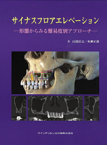 サイナスフロアエレベーション 形態からみる難易度別アプローチ【3000円以上送料無料】