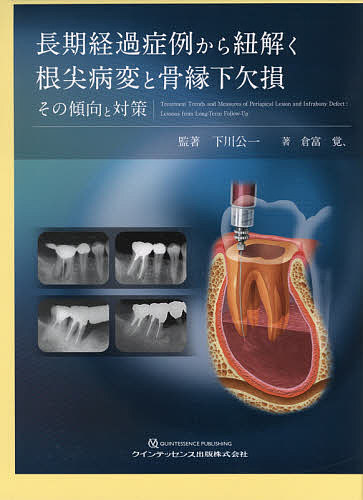 長期経過症例から紐解く根尖病変と骨縁下欠損 その傾向と対策／下川公一／著倉富覚、【3000円以上送料無料】