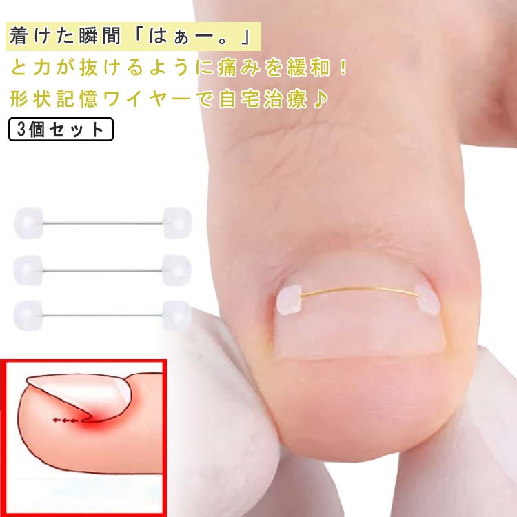 【送料無料】補正 まきつめ まきづめ 巻爪 矯正 テープ ブロック 4ヶ月 巻き爪ワイヤーガード 【巻きづめ】 足 親指 矯正 ワイヤーガー