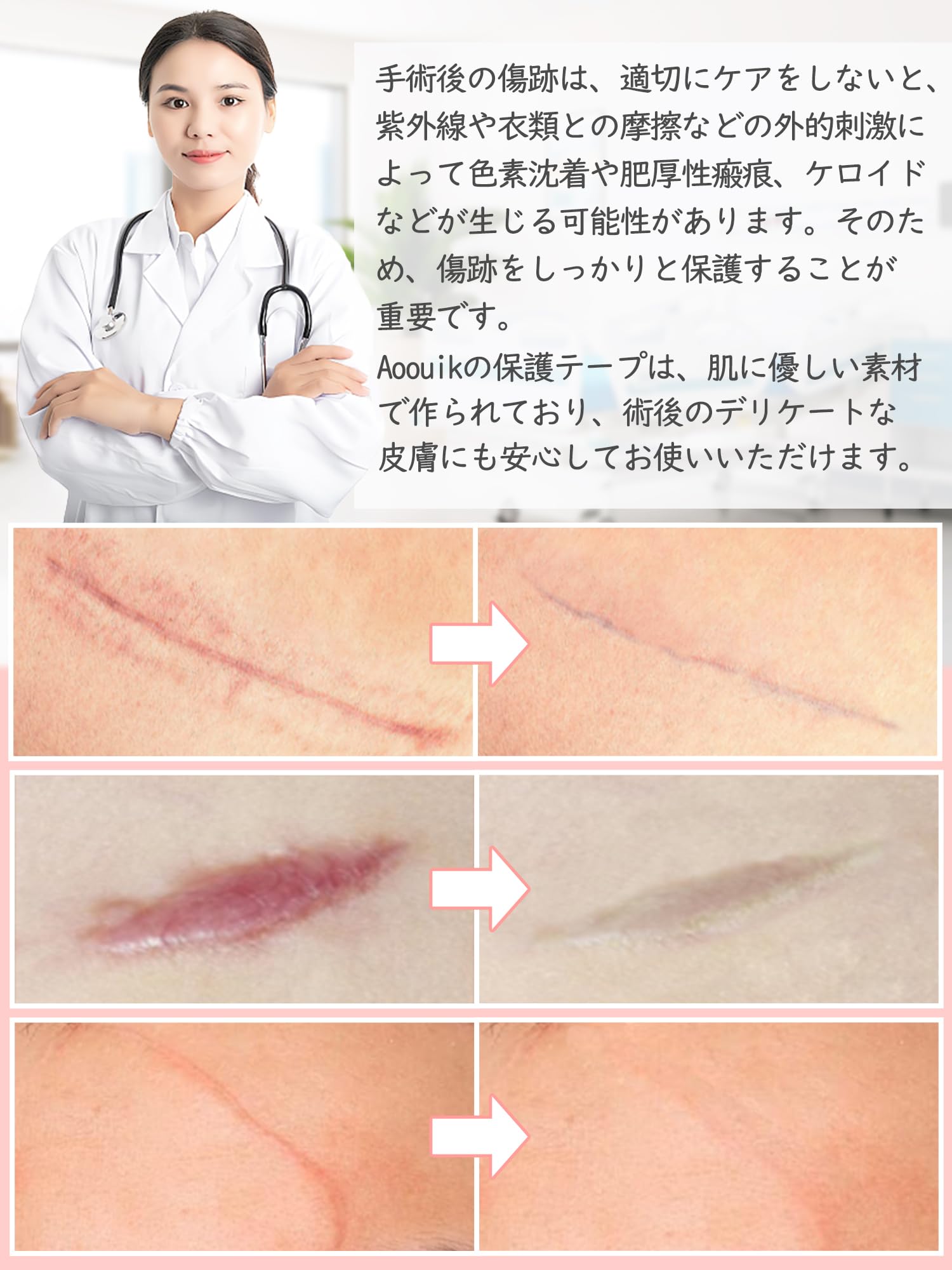 【送料無料】【美容皮膚科医推奨】傷跡ケアテープ 帝王切開 傷テープ ケロイド対策用 手術後の傷あと保護 『低刺激x肌にやさしい』シリコンジェルシート『手で切れるタイプ』（4cmx150cm） castingdoctor-10061954 キャスティングドクターショップ サンプル画像3