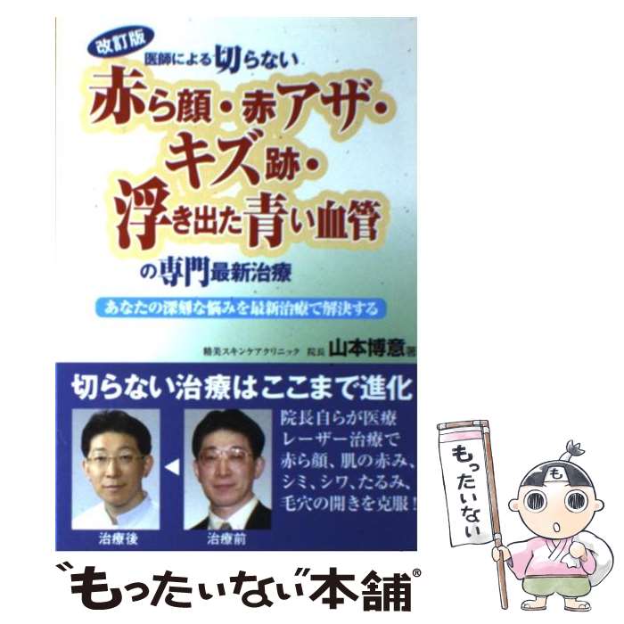 【中古】 医師による切らない「赤ら顔・赤アザ・キズ跡・浮き出た青い血管」の専門最新治療 改訂版 / 山本 博意 / 白誠書房 [単行本]【..