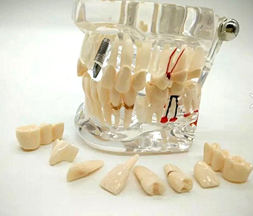 Syorn 歯科模型 歯列模型 透明 インプラント 着脱できる 研究 学習 教材 Dental Model