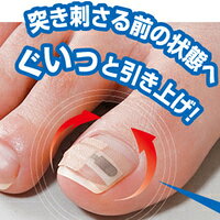 巻き爪シール 1ヶ月ケア 巻き爪対策 巻き爪 対策 シール お悩み 足 シール型 巻爪 ...