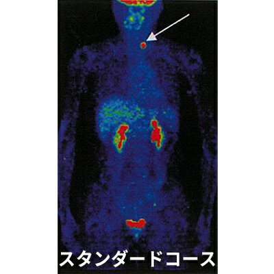 P2 スタンダードコース [ PET-CT 腫瘍マーカー がん検診 スクリーニング検査 血液検査 肝炎 萎縮性胃炎 感染症検査 小さながん 高い 確率 早期発見 早期治療 ]