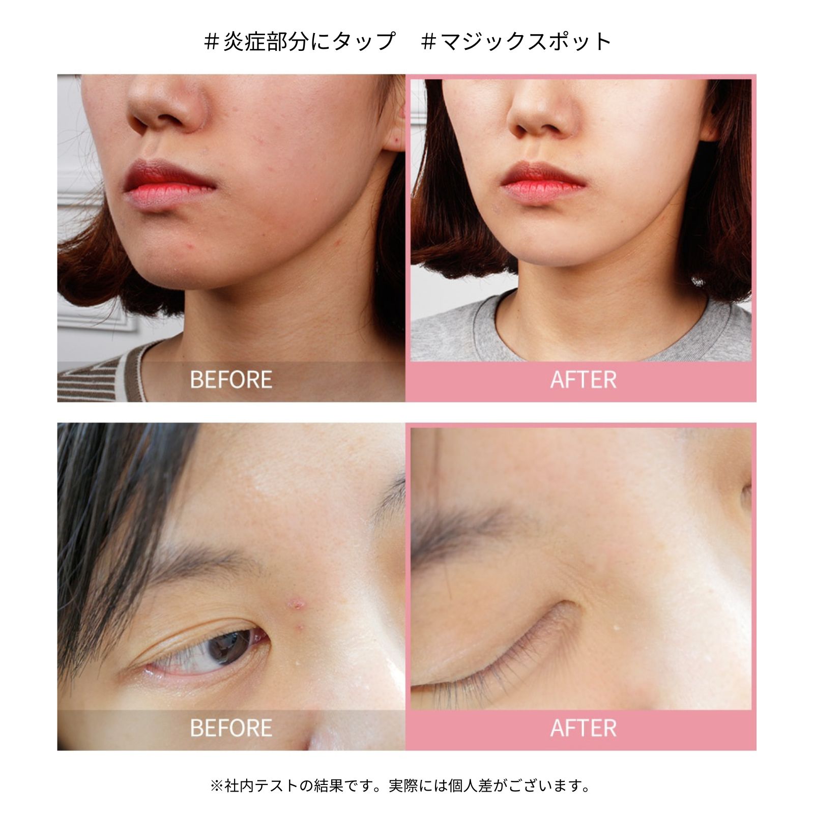 リファイニング C ピンクスポット / The YEON ザヨン 韓国 コスメ 正規品 ニキビケア アクネケア 大人にきび 顔 首 背中 肌荒れ 炎症 集中ケア カラミン成分配合 低刺激 敏感肌 混合肌 オイリー肌 トラブル肌 対策 ケア 鎮静 消炎 保湿 美容 レディース メンズ 韓国製