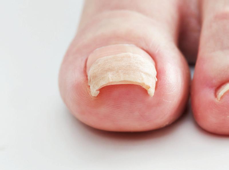 コジット 巻爪ケア PROサポートシール ナチュラル 80枚 (x 1)