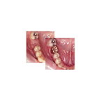 欠損歯列をつくらない、拡大させない臨床 ?歯牙移動、移植、インプラントをとおして? DVD1枚 GC ジーシー