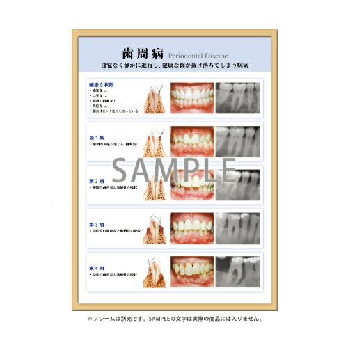 フレームアート 歯周病 453×604mm 1枚入 SmartPractice