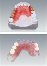 ノンクラスプデンチャー 上顎 松風