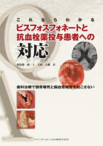 【中古】 これならわかるビスフォスフォネートと抗血栓薬投与患者への対応