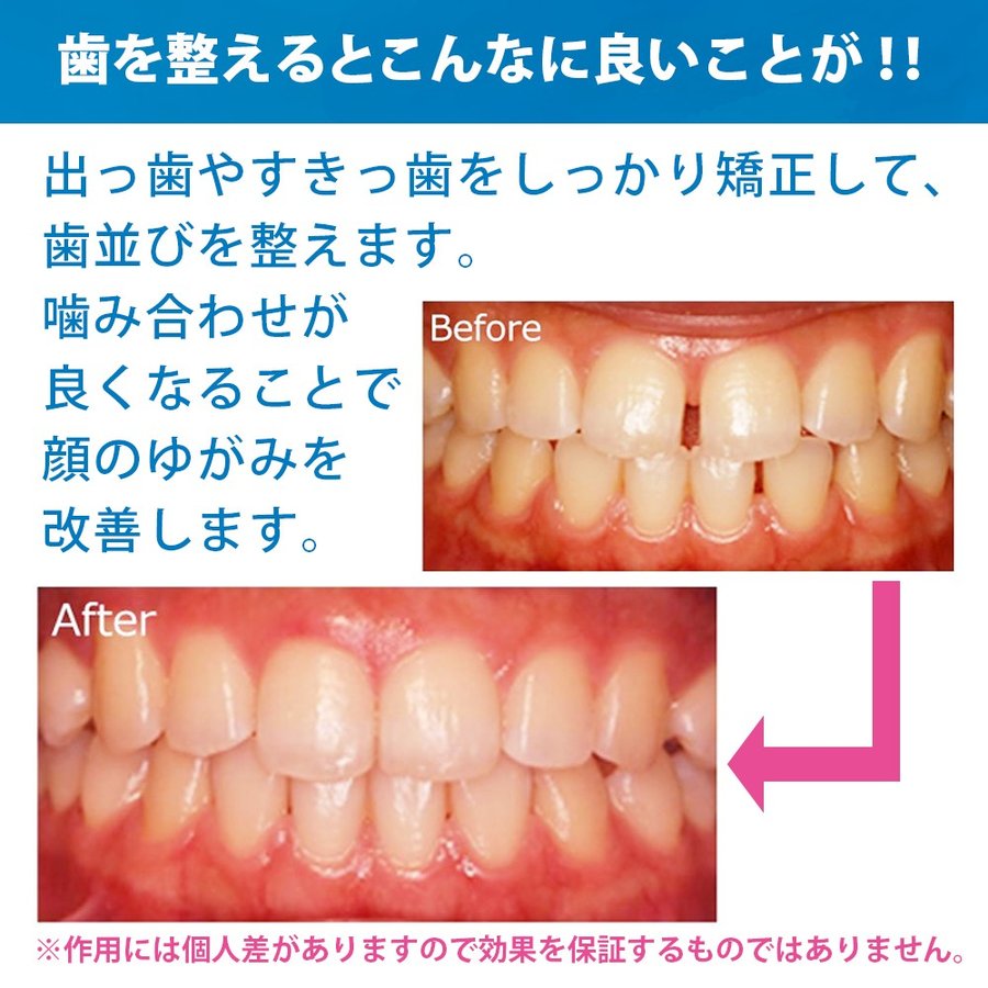 デンタル マウスピース 2個セット 噛み合わせ 歯ぎしり いびき 防止 予防 歯列 歯並び 出っ歯 すきっ歯 安眠 快眠 送料無料【CJ-1〜3】