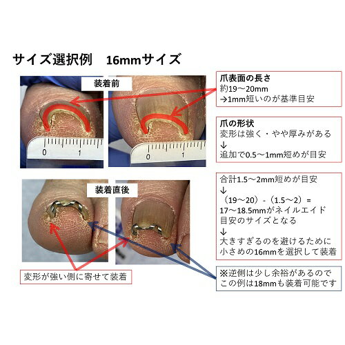 巻き爪治し方自分で巻き爪治療【ネイルエイド】まきづめ矯正リフト爪ブロックガードケア14mm