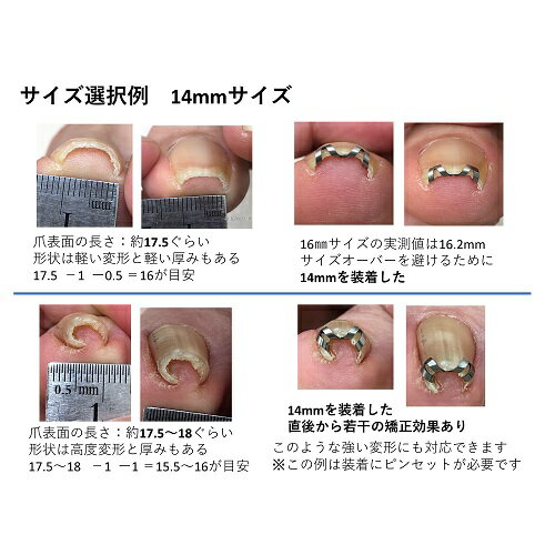 巻き爪治し方自分で巻き爪治療【ネイルエイド】まきづめ矯正リフト爪ブロックガードケア14mm