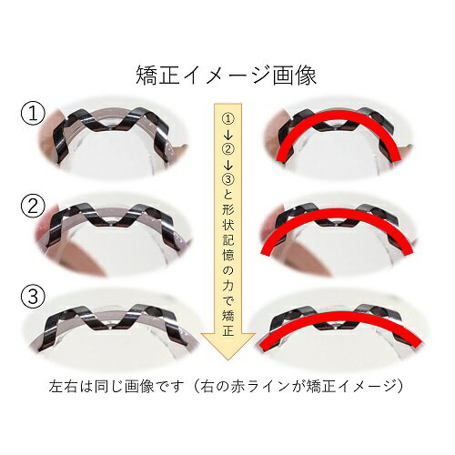 巻き爪治し方自分で巻き爪治療【ネイルエイド】まきづめ矯正リフト爪ブロックガードケア14mm
